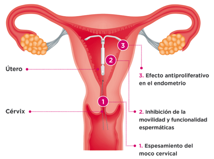 Qué es un dispositivo intrauterino (DIU)? - Embarazo y Bebes