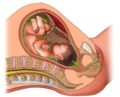Infección de estreptococo grupo B durante el embarazo