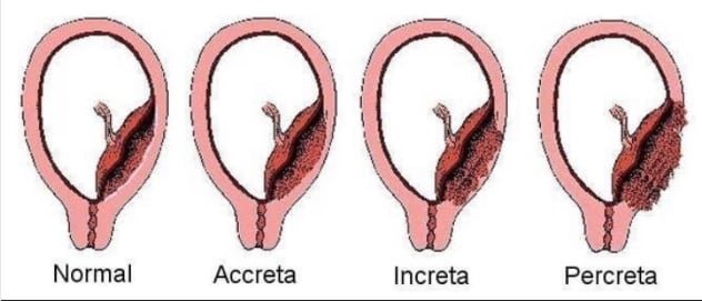 ¿Qué anomalías puede tener la placenta?
